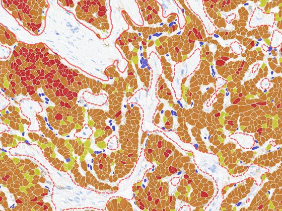 Breast HER2 AI markup