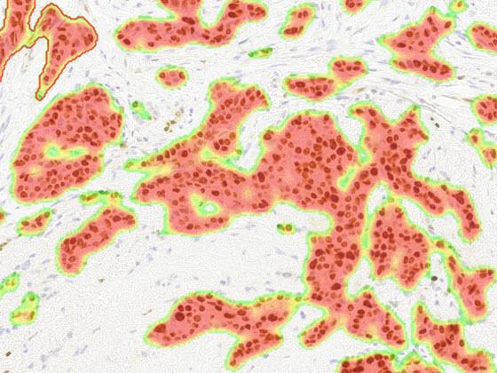 Breast PR AI tumor heatmap markup
