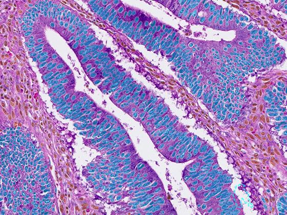 CRC Macrodissect AI scoring markup