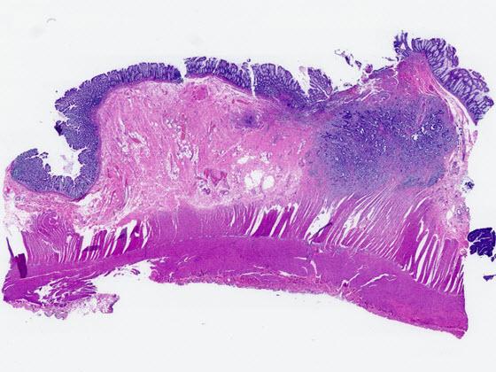 H&E stained colorectal tissue