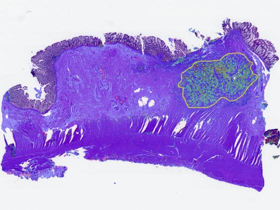 CRC Macrodissect AI tumor heatmap