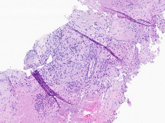  H&E stained tissue with folds