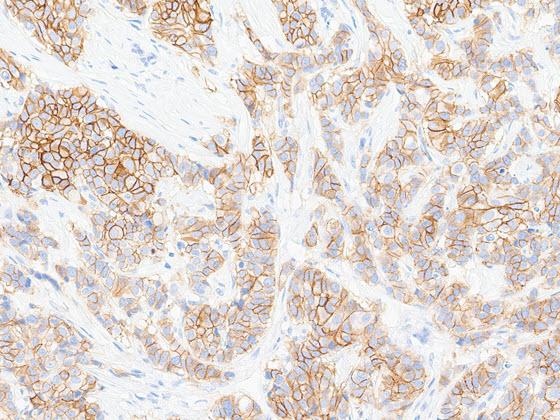HER2 IHC-stained breast cancer