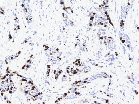 Ki67 IHC-stained breast cancer 