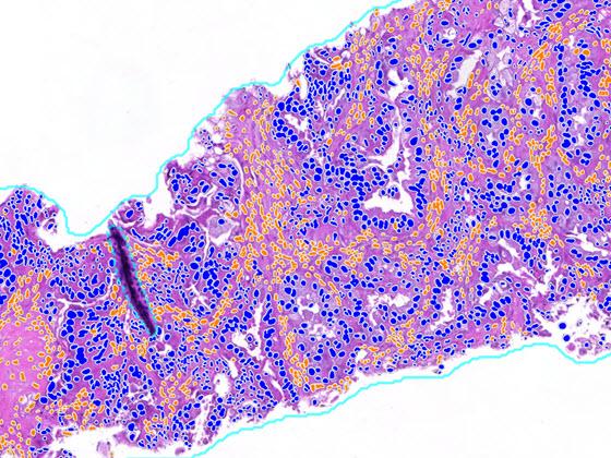 Lung Macrodissect AI scoring markup