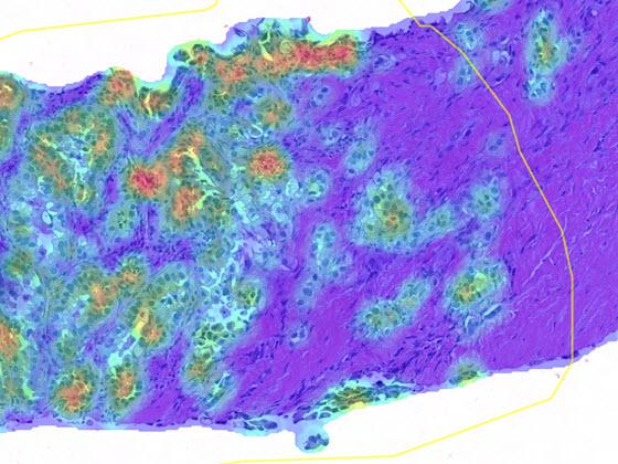 Lung Macrodissect AI tumor heatmap, zoomed in