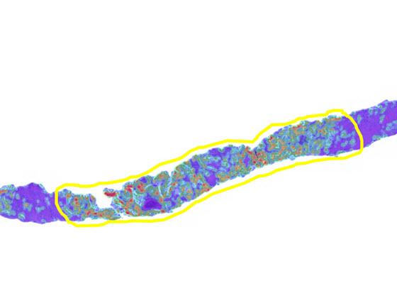 Lung Macrodissect AI tumor heatmap