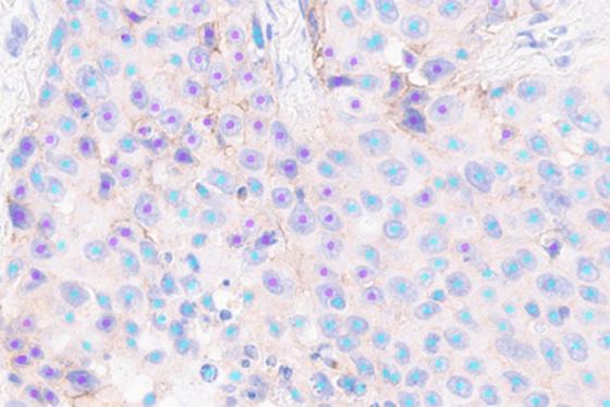 Instant and automated identification of PD-L1 positive and negative tumor cells