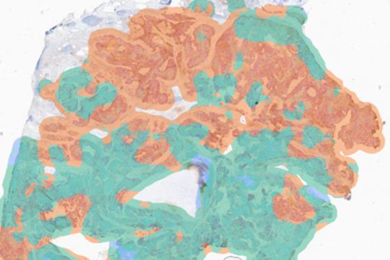 Visualization of PD-L1 expression on the heatmap