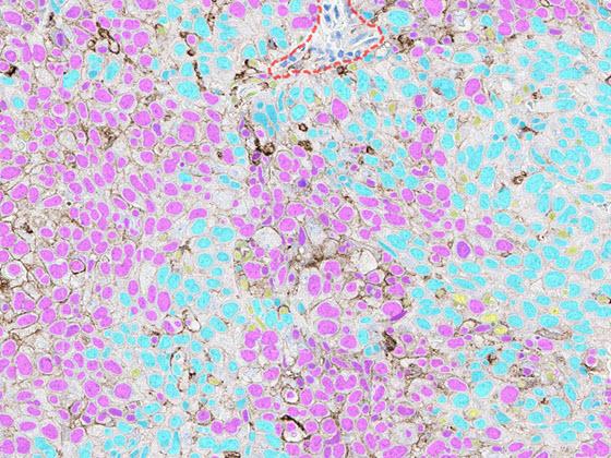 Lung PD-L1 AI scoring markup