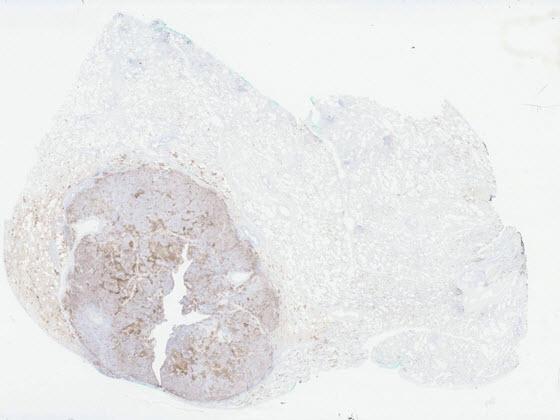PD-L1 IHC stained lung tissue
