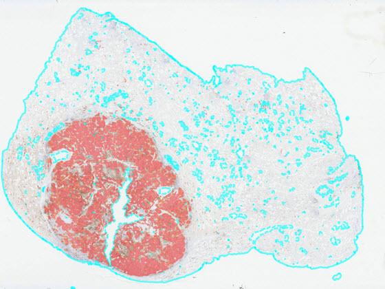 Lung PD-L1 AI tumor heatmap