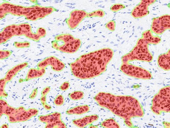 Breast ER AI tumor heatmap markup 