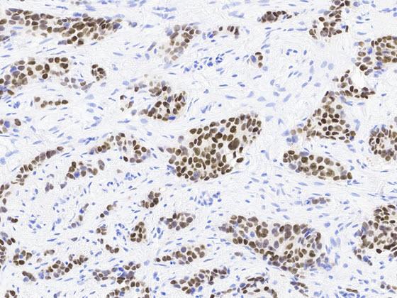  ER IHC-stained breast cancer 