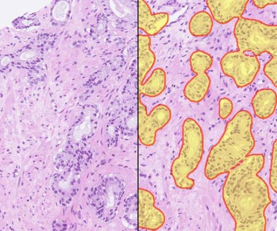 halo-prostate-ai-Split-600x500