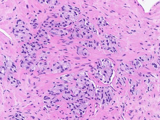 prostate-ai-carousel-img_1_560x420