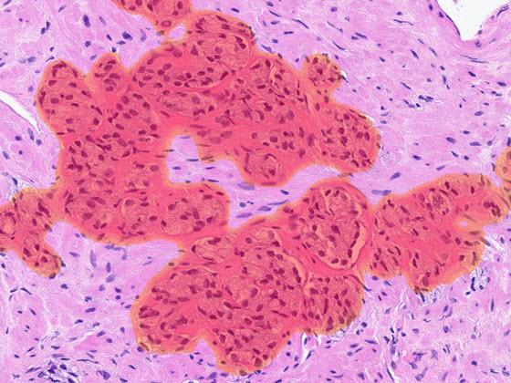 prostate-ai-carousel-img_2_560x420