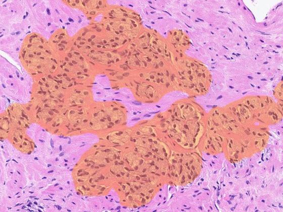 HALO-Prostate-AI-carousel-img-03