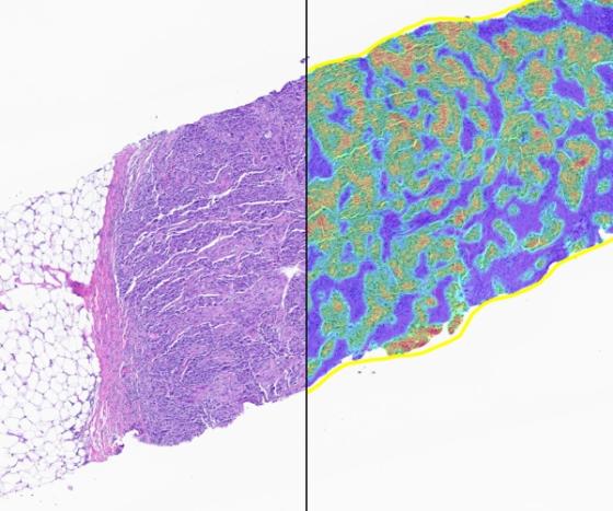 Breast Macrodissect AI