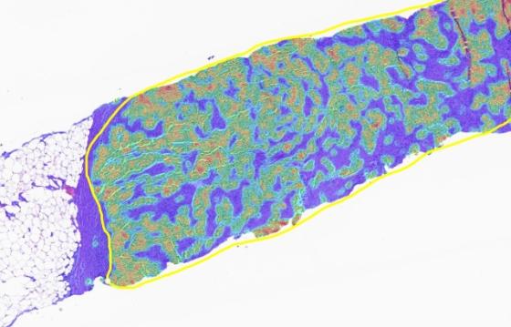Step 2: Tumor Density Heatmap