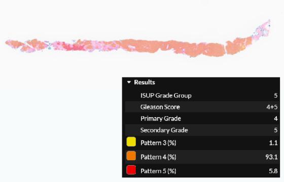 Automated Gleason Grading and Detection
