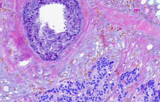 Step 3: Cancer Cell Classification