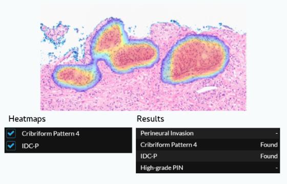 High-Risk Histological Features