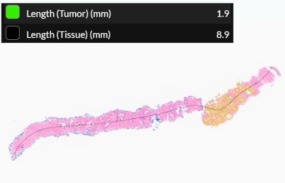 Tumor Burden – Length Metrics