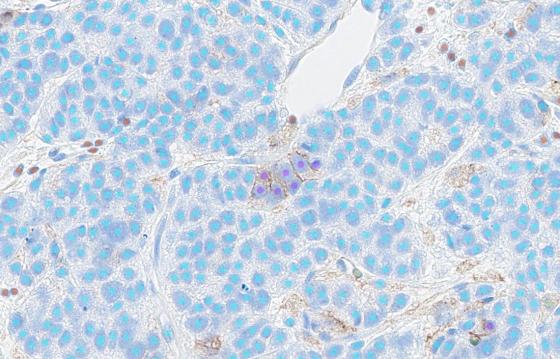 Instant and automated identification of PD-L1 positive and negative tumor cells & immune cells