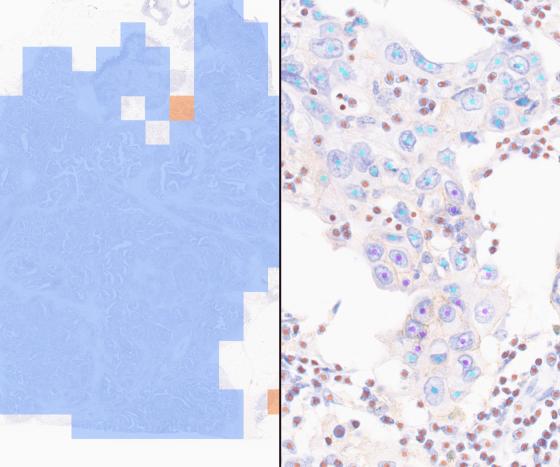 Lunit SCOPE PD-L1 22C3 Breast (RUO)