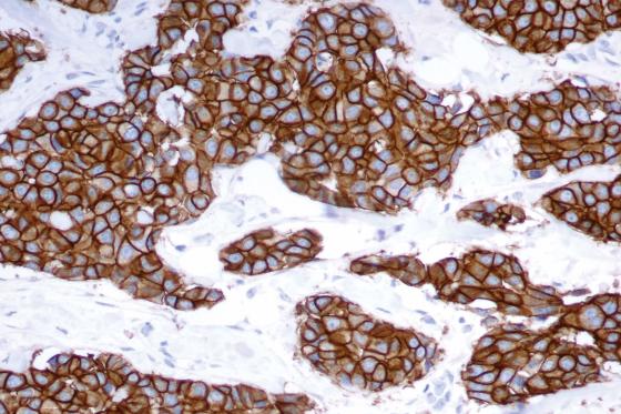 Human breast carcinoma: immunohistochemical staining for c-erbB-2 oncoprotein using Bond Oracle HER2 IHC System. Note intense membrane staining of tumor cells. Paraffin section.