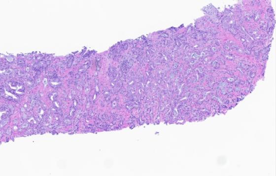 Prostate Cancer H&E Image