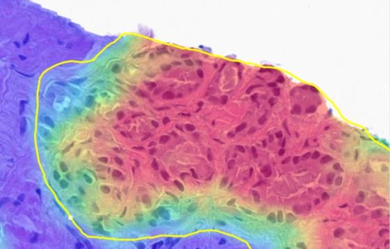 Tumor Density Heatmap (Higher Resolution)