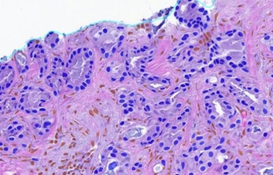 Cancer Cell Classification