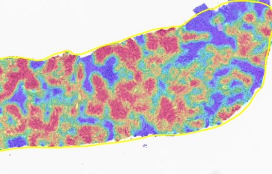 Tumor Density Heatmap 