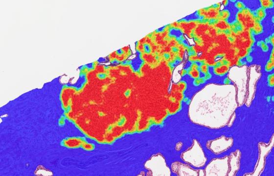 heatmap_5x_prostate