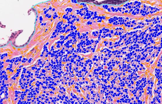 tumor_detection_20x_1920x1230