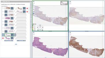 Figure 6: Digital pathology enables multiple digital slides to be viewed simultaneously, aligning them side-by-side for improved comparison between different tissue sections and IHC markers.