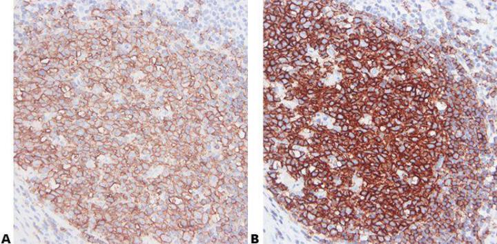 These sections of human tonsil from the same block have been stained with the B cell marker CD20 using primary monoclonal antibodies from different sources (suppliers). In each case, the recommended pretreatment and optimized dilution were used. There is an obvious difference in the quality of the results achieved.