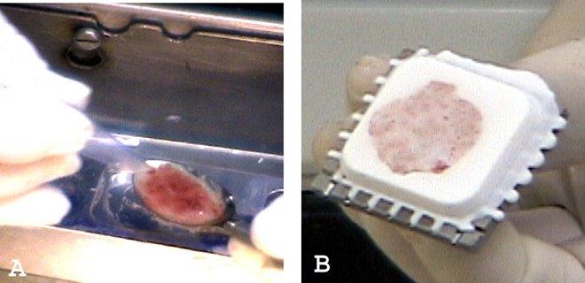 Figure 5. Liquid specimens easily embedded in these wells without crushing by a heat extractor. (A) Liquid tissues placed in the well using a spoon. (B) The embedded liquid forms a three-dimensional block which can be cut for frozen section while still preserving tissue for permanent sections. The specimen is prepared embedding medium. Figure 5. Liquid specimens easily embedded in these wells without crushing by a heat extractor. (A) Liquid tissues placed in the well using a spoon. (B) The embedded liquid forms a three-dimensional block which can be cut for frozen section while still preserving tissue for permanent sections. The specimen is prepared embedding medium.