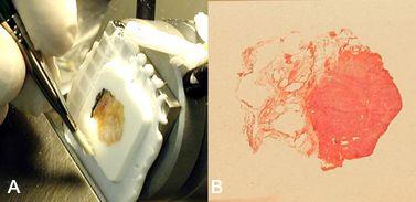 Figure 8. Orienting fat containing tissue to the blade. (A) A trimmed block showing a breast tumor with the inked fatty margin oriented perpendicular to the knife blade. The fatty tissue is cut without interfering with the tumor tissue and the margin is best preserved in this vertical section. (B) Close up of slide cut from block in 2(A) showing an adequate section containing the fatly tissue and clearly visible resection margin at left. Figure 8. Orienting fat containing tissue to the blade. (A) A trimmed block showing a breast tumor with the inked fatty margin oriented perpendicular to the knife blade. The fatty tissue is cut without interfering with the tumor tissue and the margin is best preserved in this vertical section. (B) Close up of slide cut from block in 2(A) showing an adequate section containing the fatly tissue and clearly visible resection margin at left.