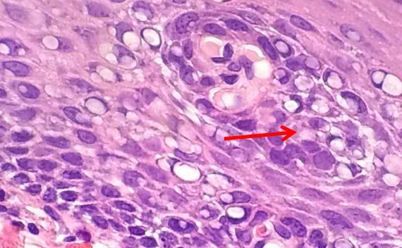 Figure 10 The bubbling is clear in this image. High heat and acidic formalin can cause protein coagulation that may impair diagnosis. Figure 10 The bubbling is clear in this image. High heat and acidic formalin can cause protein coagulation that may impair diagnosis.