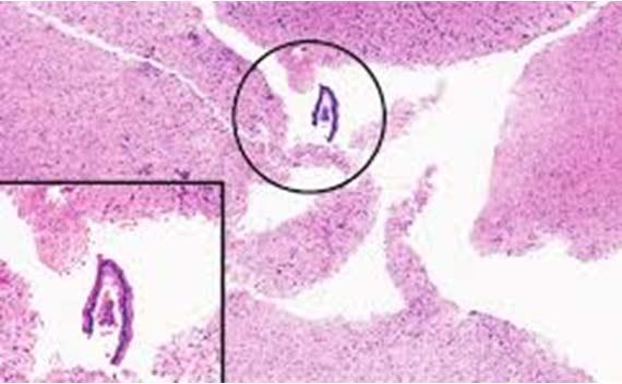 Figure 11 This section of brain tissue has an extraneous piece of enteric tissue. Most likely, the contamination occurred during specimen grossing, there is no way to confirm its origin. Photo Credit: Sehn, JK et. al., Occult Specimen Contamination in Routine Clinical Next-Generation Sequencing Testing. Am J ClinPathol October 2015; 144:667-674. Figure 11 This section of brain tissue has an extraneous piece of enteric tissue. Most likely, the contamination occurred during specimen grossing, there is no way to confirm its origin. Photo Credit: Sehn, JK et. al., Occult Specimen Contamination in Routine Clinical Next-Generation Sequencing Testing. Am J ClinPathol October 2015; 144:667-674.