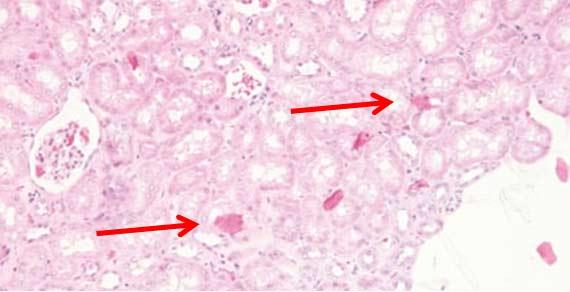 Figure 12 This section of kidney has extraneous squamous cells above the plane of the tissue. Contaminants of this type can occur within the water bath or during staining. Photo Credit: Leica Biosystems Steps to better Microtomy. Figure 12 This section of kidney has extraneous squamous cells above the plane of the tissue. Contaminants of this type can occur within the water bath or during staining. Photo Credit: Leica Biosystems Steps to better Microtomy.