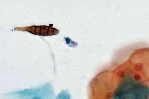 Figure 13 Alternaria, an airborne fungus, as seen on a Pap smear. Photo Credit: http://pathos223.com/en/case/case237.htm Figure 13 Alternaria, an airborne fungus, as seen on a Pap smear. Photo Credit: http://pathos223.com/en/case/case237.htm