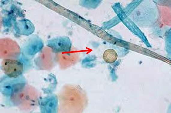 Figure 14 Fibers possibly from the slide folder or the collection device used on the patient can be seen on this Pap smear. Photo Credit: http://pathos223.com/en/case/case237.htm