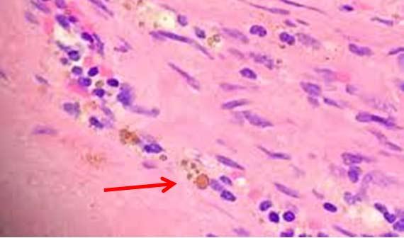 Figure 15 Hemosiderin pigment on a section of tissue. Figure 15 Hemosiderin pigment on a section of tissue.