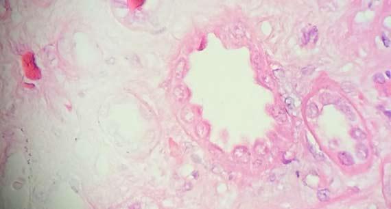 Figure 6 The uneven staining in this section is a direct result of not enough time in in xylene to remove all of the paraffin from the tissue. This artifact is also seen when the support media for frozen sections has not been adequately remove. Figure 6 The uneven staining in this section is a direct result of not enough time in in xylene to remove all of the paraffin from the tissue. This artifact is also seen when the support media for frozen sections has not been adequately remove.