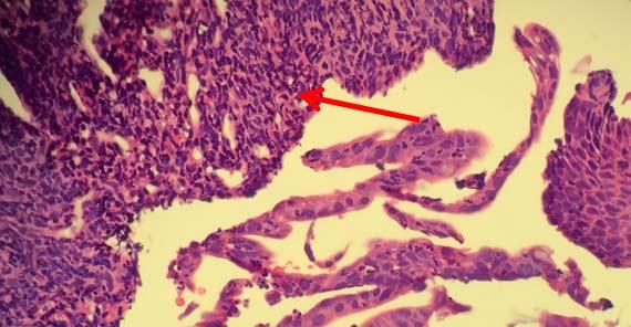 Figure 8 In this image, the seared appearance of the nuclei can hamper diagnosis due to the loss of nuclear detail.