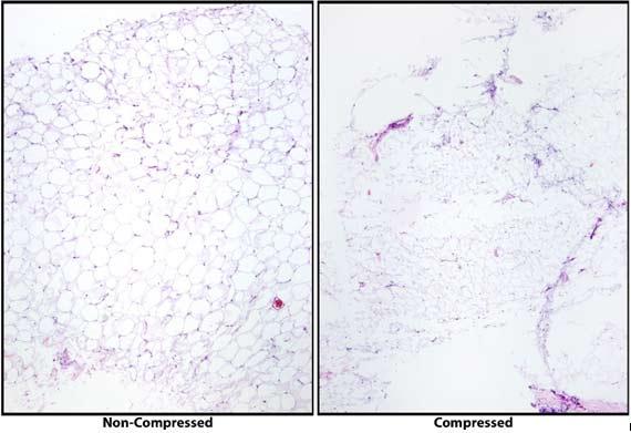 Figure 9 This image shows the compression of under processed tissues. Note how the slide on the right is damaged and the details of the fat cells are compromised, indicating that the sample was not properly infiltrated. Photo credit: Stanley Hansen Figure 9 This image shows the compression of under processed tissues. Note how the slide on the right is damaged and the details of the fat cells are compromised, indicating that the sample was not properly infiltrated. Photo credit: Stanley Hansen